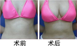 丰胸哪家医院好,国内哪家医院丰胸效果最佳？”